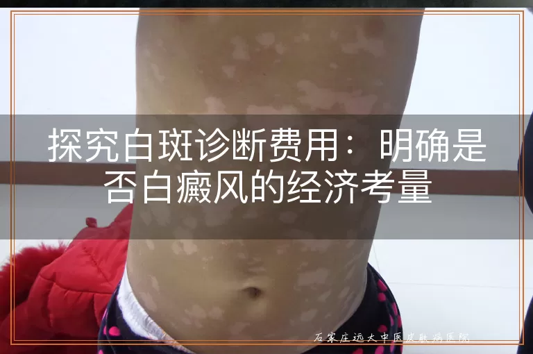 探究白斑诊断费用：明确是否白癜风的经济考量