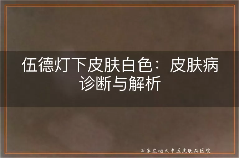 伍德灯下皮肤白色：皮肤病诊断与解析