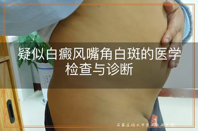 疑似白癜风嘴角白斑的医学检查与诊断