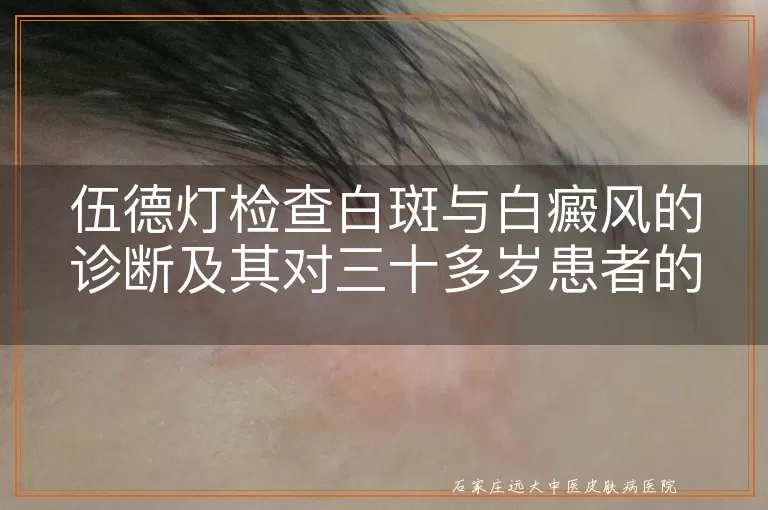 伍德灯检查白斑与白癜风的诊断及其对三十多岁患者的潜在危害