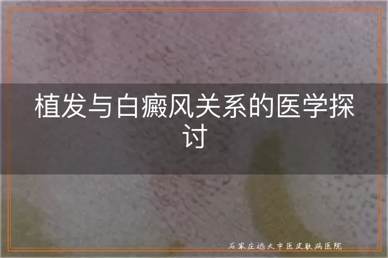 植发与白癜风关系的医学探讨