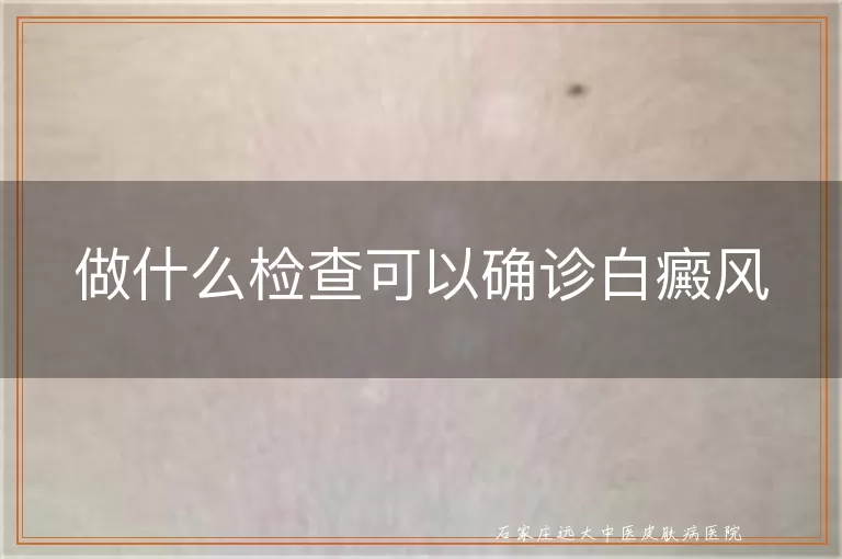 做什么检查可以确诊白癜风