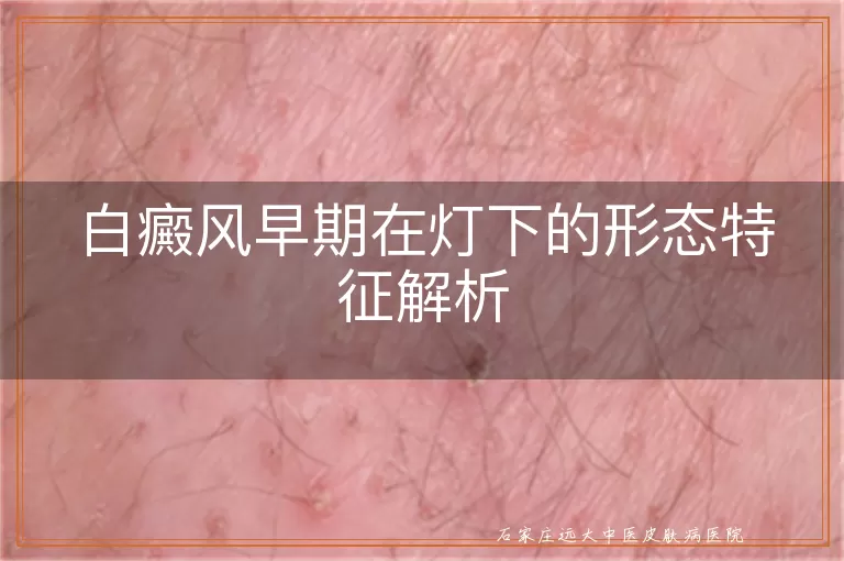 白癜风早期在灯下的形态特征解析