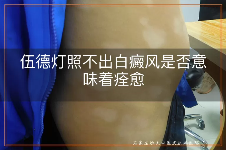 伍德灯照不出白癜风是否意味着痊愈