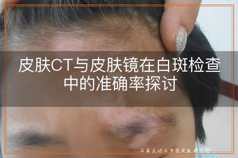 皮肤CT与皮肤镜在白斑检查中的准确率探讨