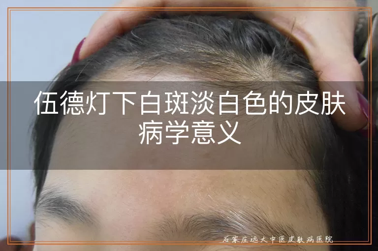 伍德灯下白斑淡白色的皮肤病学意义