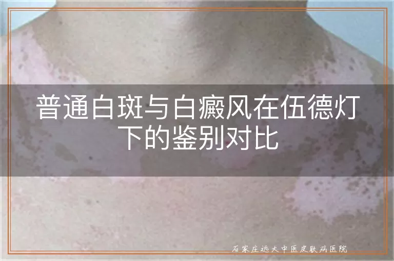 普通白斑与白癜风在伍德灯下的鉴别对比