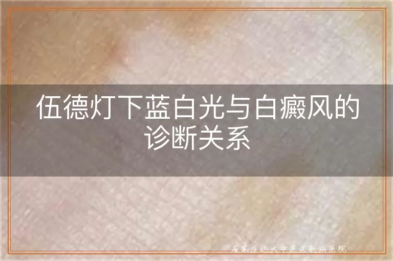 伍德灯下蓝白光与白癜风的诊断关系