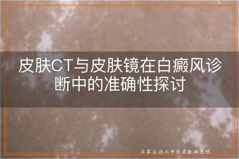 皮肤CT与皮肤镜在白癜风诊断中的准确性探讨