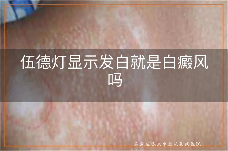 伍德灯显示发白就是白癜风吗