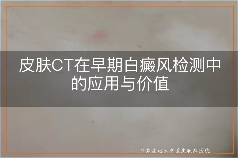 皮肤CT在早期白癜风检测中的应用与价值