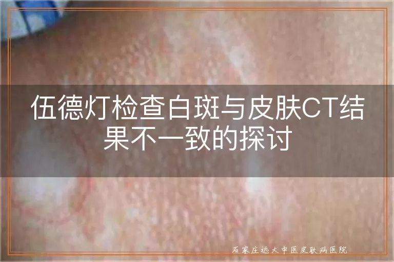伍德灯检查白斑与皮肤CT结果不一致的探讨