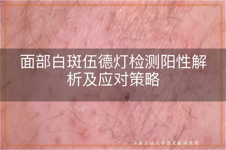 面部白斑伍德灯检测阳性解析及应对策略