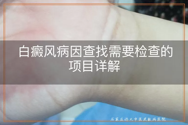 白癜风病因查找需要检查的项目详解