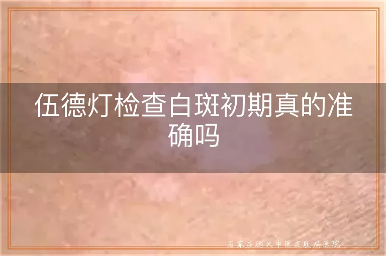 伍德灯检查白斑初期真的准确吗