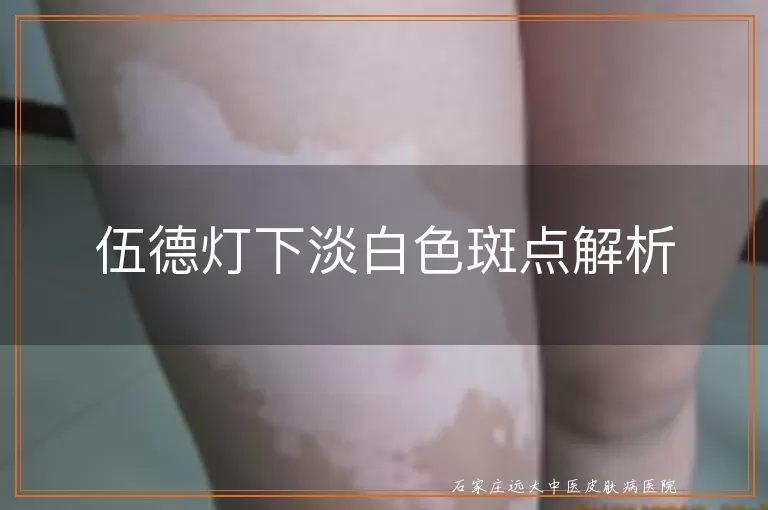 伍德灯下淡白色斑点解析