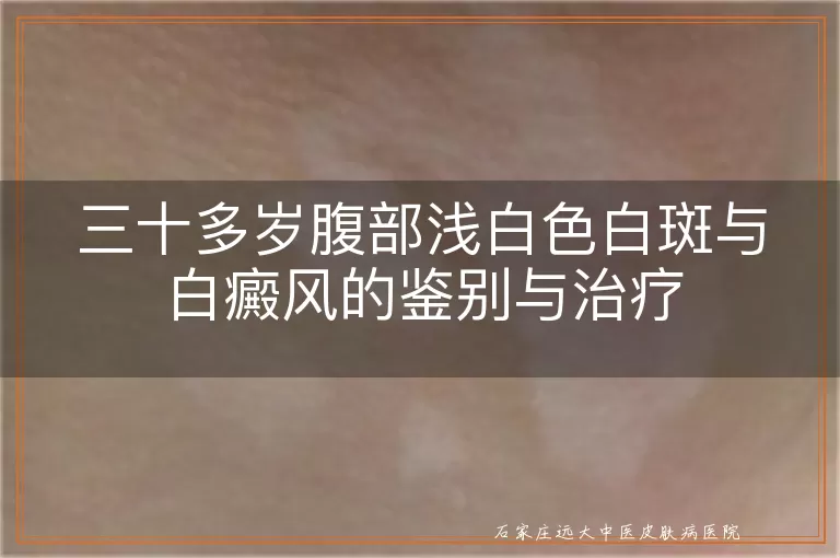 三十多岁腹部浅白色白斑与白癜风的鉴别与治疗