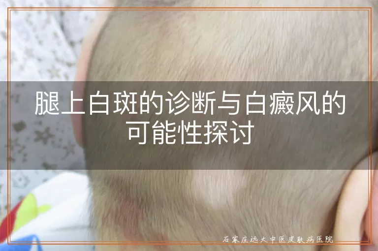 腿上白斑的诊断与白癜风的可能性探讨