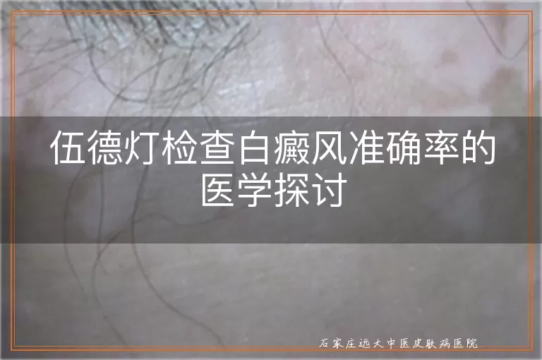 伍德灯检查白癜风准确率的医学探讨