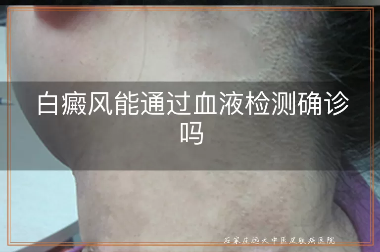 白癜风能通过血液检测确诊吗