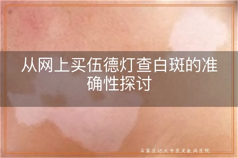 从网上买伍德灯查白斑的准确性探讨
