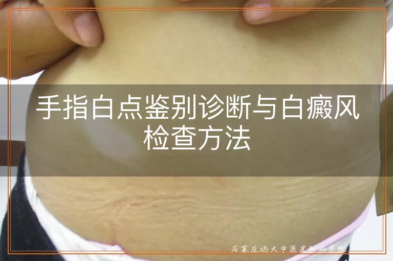 手指白点鉴别诊断与白癜风检查方法