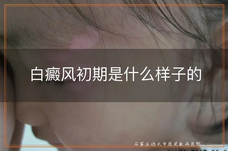 白癜风初期是什么样子的