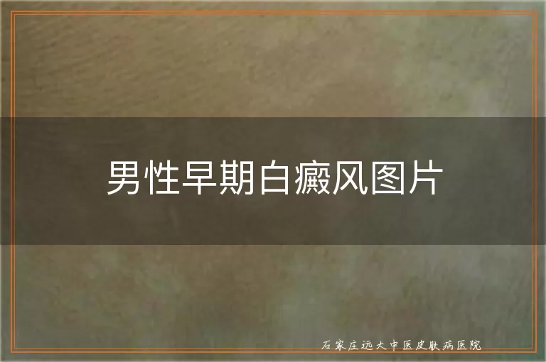 男性早期白癜风图片
