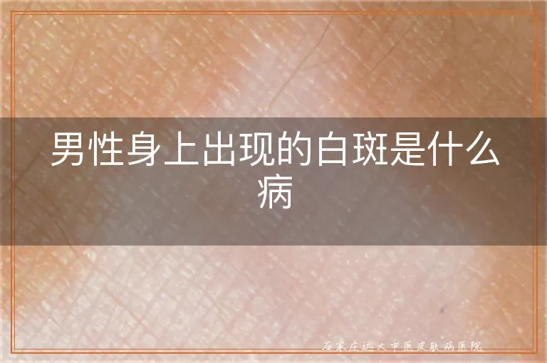 男性身上出现的白斑是什么病