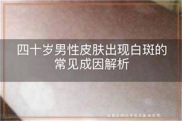 四十岁男性皮肤出现白斑的常见成因解析