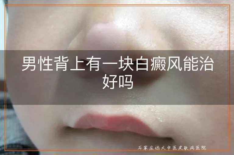 男性背上有一块白癜风能治好吗