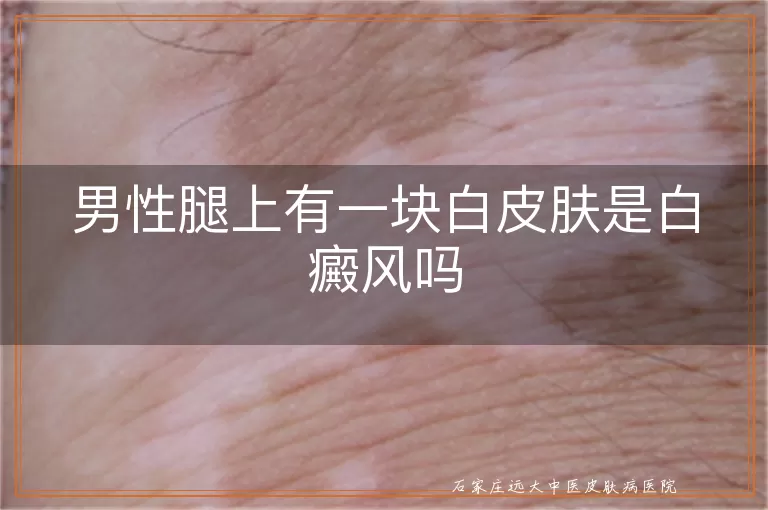 男性腿上有一块白皮肤是白癜风吗