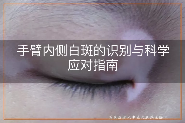 手臂内侧白斑的识别与科学应对指南