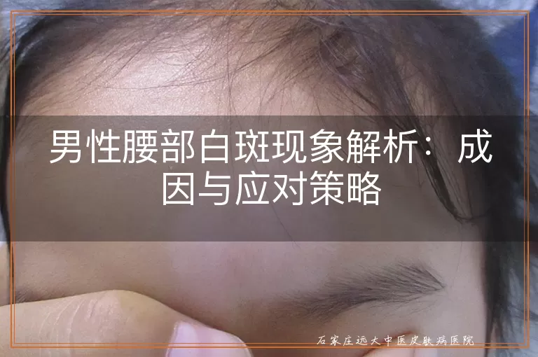 男性腰部白斑现象解析:成因与应对策略