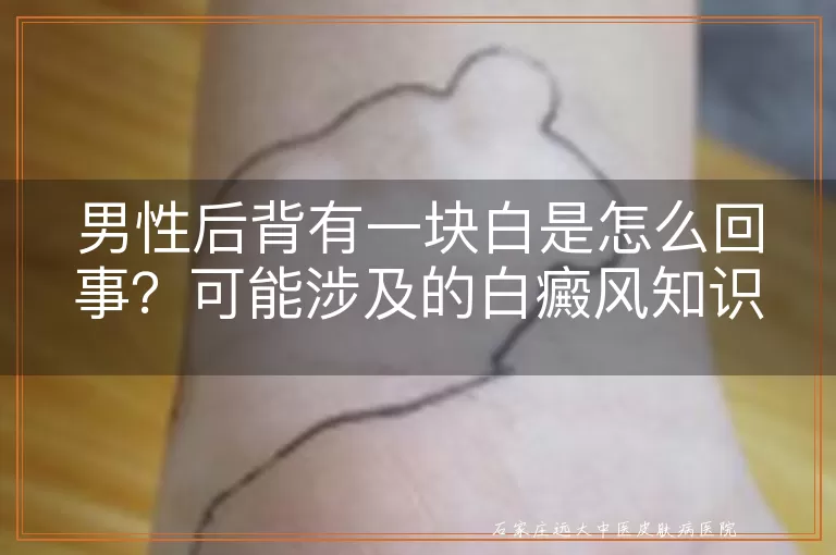 男性后背有一块白是怎么回事？可能涉及的白癜风知识解析