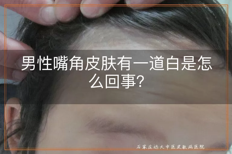 男性嘴角皮肤有一道白是怎么回事？