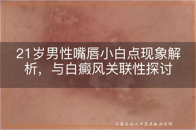 21岁男性嘴唇小白点现象解析，与白癜风关联性探讨