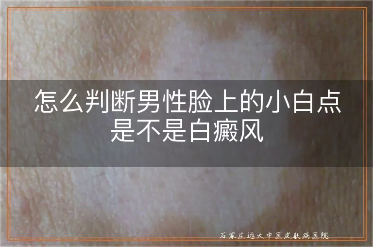 怎么判断男性脸上的小白点是不是白癜风