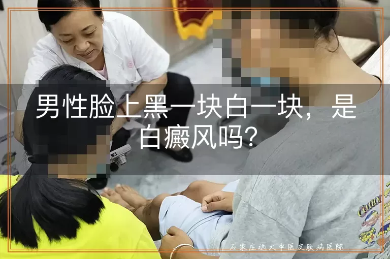男性脸上黑一块白一块，是白癜风吗？