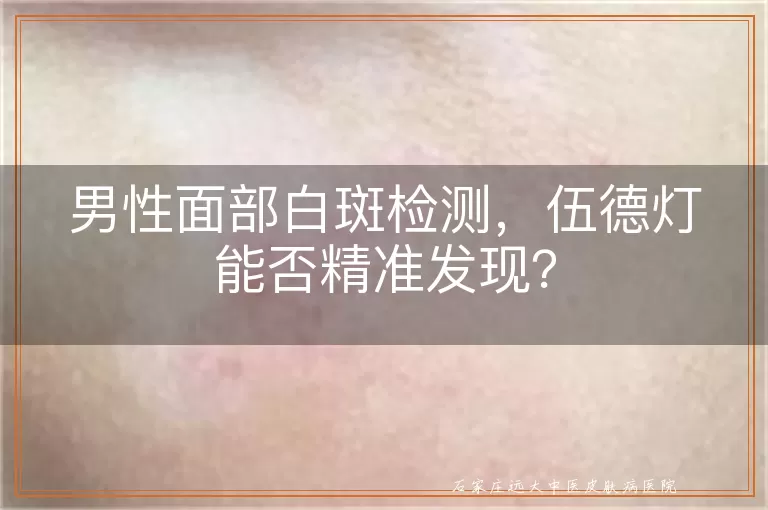 男性面部白斑检测，伍德灯能否精准发现？