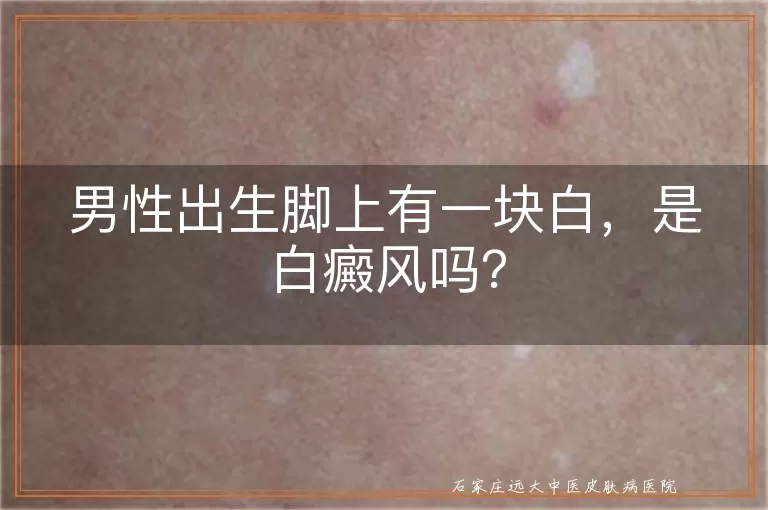 男性出生脚上有一块白，是白癜风吗？