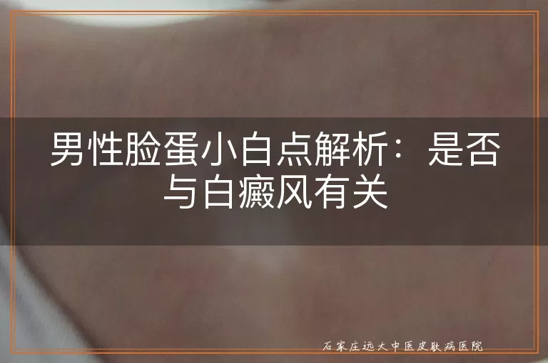 男性脸蛋小白点解析:是否与白癜风有关