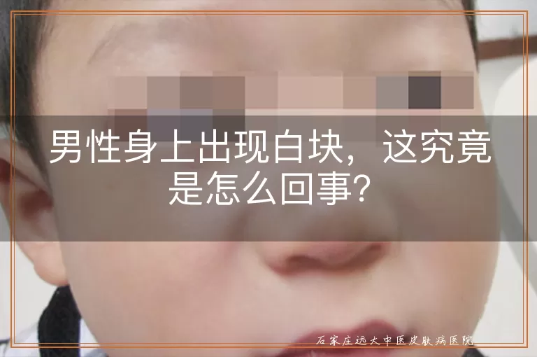 男性身上出现白块，这究竟是怎么回事？