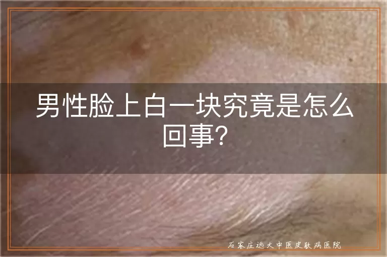 男性脸上白一块究竟是怎么回事？