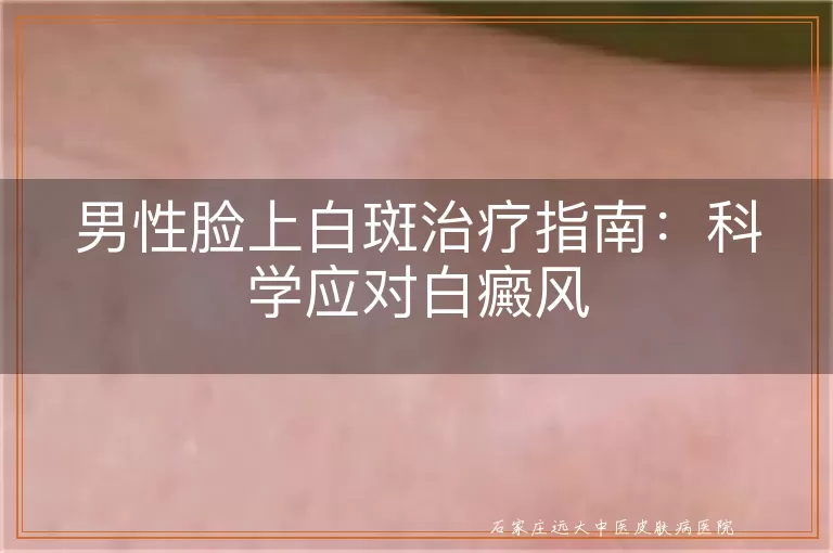 男性脸上白斑治疗指南：科学应对白癜风