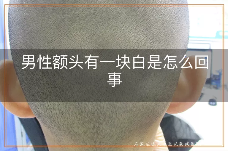 男性额头有一块白是怎么回事