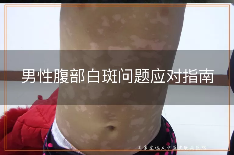 男性腹部白斑问题应对指南