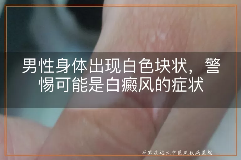 男性身体出现白色块状，警惕可能是白癜风的症状