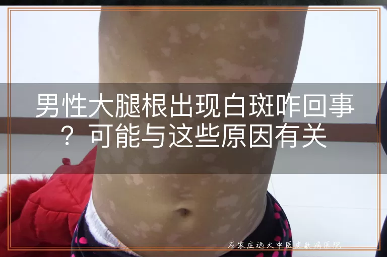 男性大腿根出现白斑咋回事？可能与这些原因有关