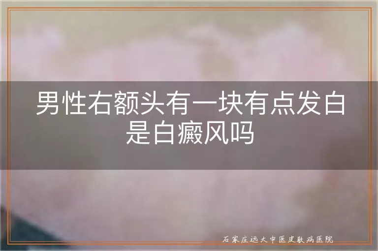 男性右额头有一块有点发白是白癜风吗